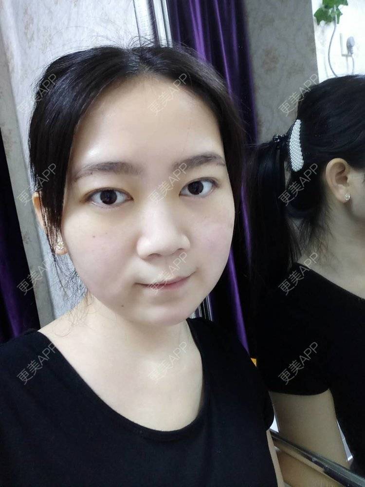 更美 - 更美用户HOXcRi8TmU的膨体垫眉弓经验 | 膨体垫眉弓