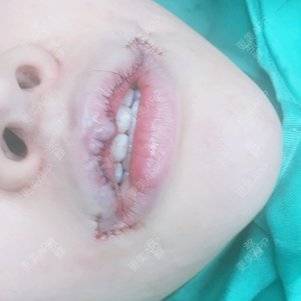更美 - 更美用户kvJsJX5BDg的拉皮经验 | 深圳 | 拉皮