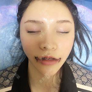 更美 - 更美用户kvJsJX5BDg的拉皮经验 | 深圳 | 拉皮