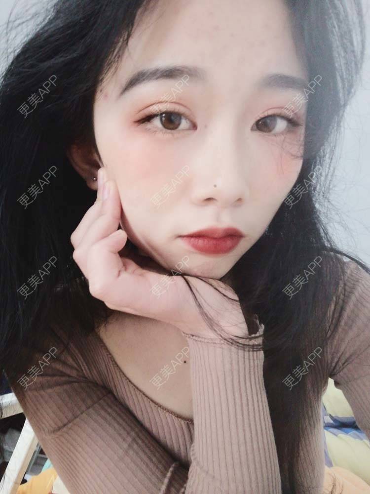 更美 - 更美用户Aj86YxCPkz的吸脂瘦脸经验 | 注射塑形腿部 | 肩部吸脂 | 注射塑形肩部 | 吸脂瘦脸
