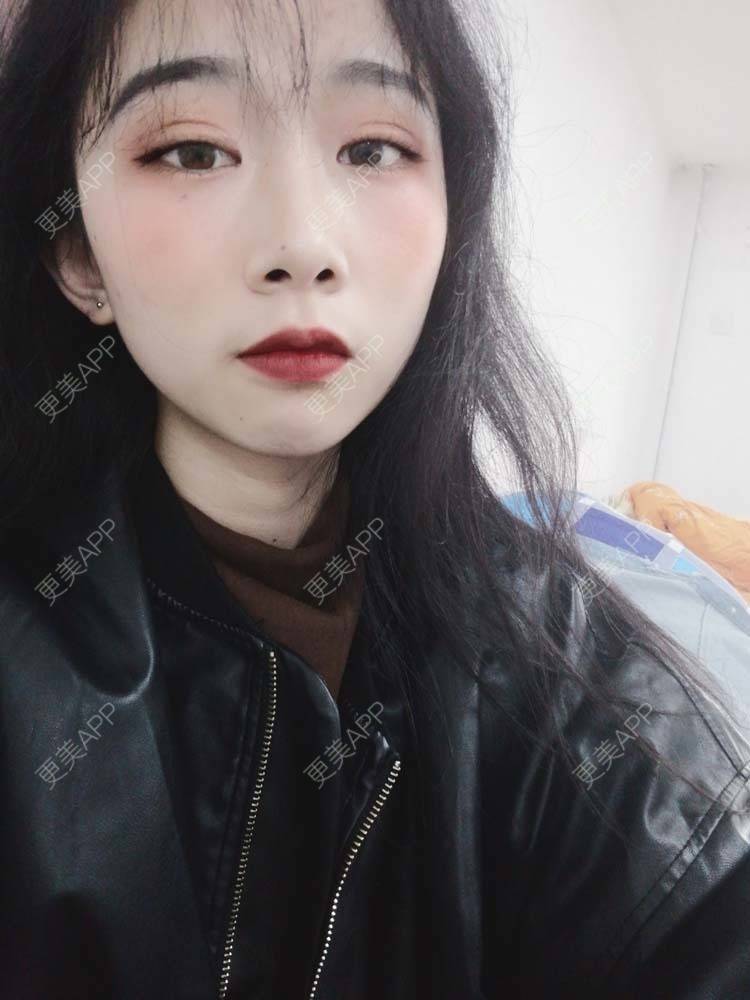 更美 - 更美用户Aj86YxCPkz的吸脂瘦脸经验 | 注射塑形腿部 | 肩部吸脂 | 注射塑形肩部 | 吸脂瘦脸