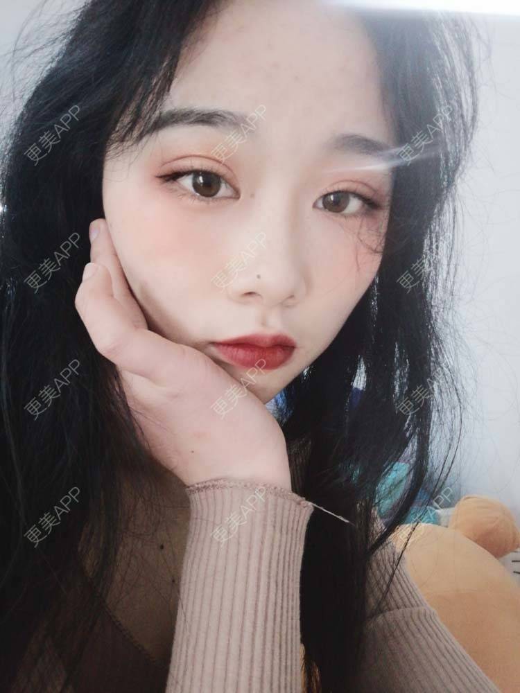 更美 - 更美用户Aj86YxCPkz的吸脂瘦脸经验 | 注射塑形腿部 | 肩部吸脂 | 注射塑形肩部 | 吸脂瘦脸