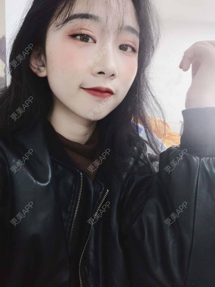更美 - 更美用户Aj86YxCPkz的吸脂瘦脸经验 | 注射塑形腿部 | 肩部吸脂 | 注射塑形肩部 | 吸脂瘦脸