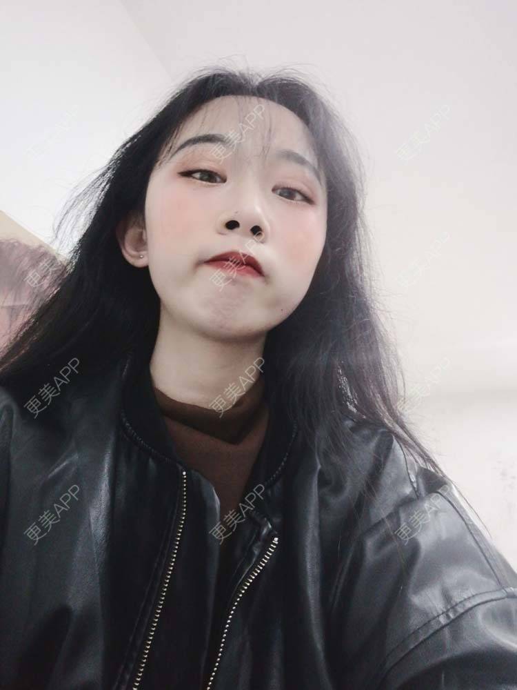 更美 - 更美用户Aj86YxCPkz的吸脂瘦脸经验 | 注射塑形腿部 | 肩部吸脂 | 注射塑形肩部 | 吸脂瘦脸