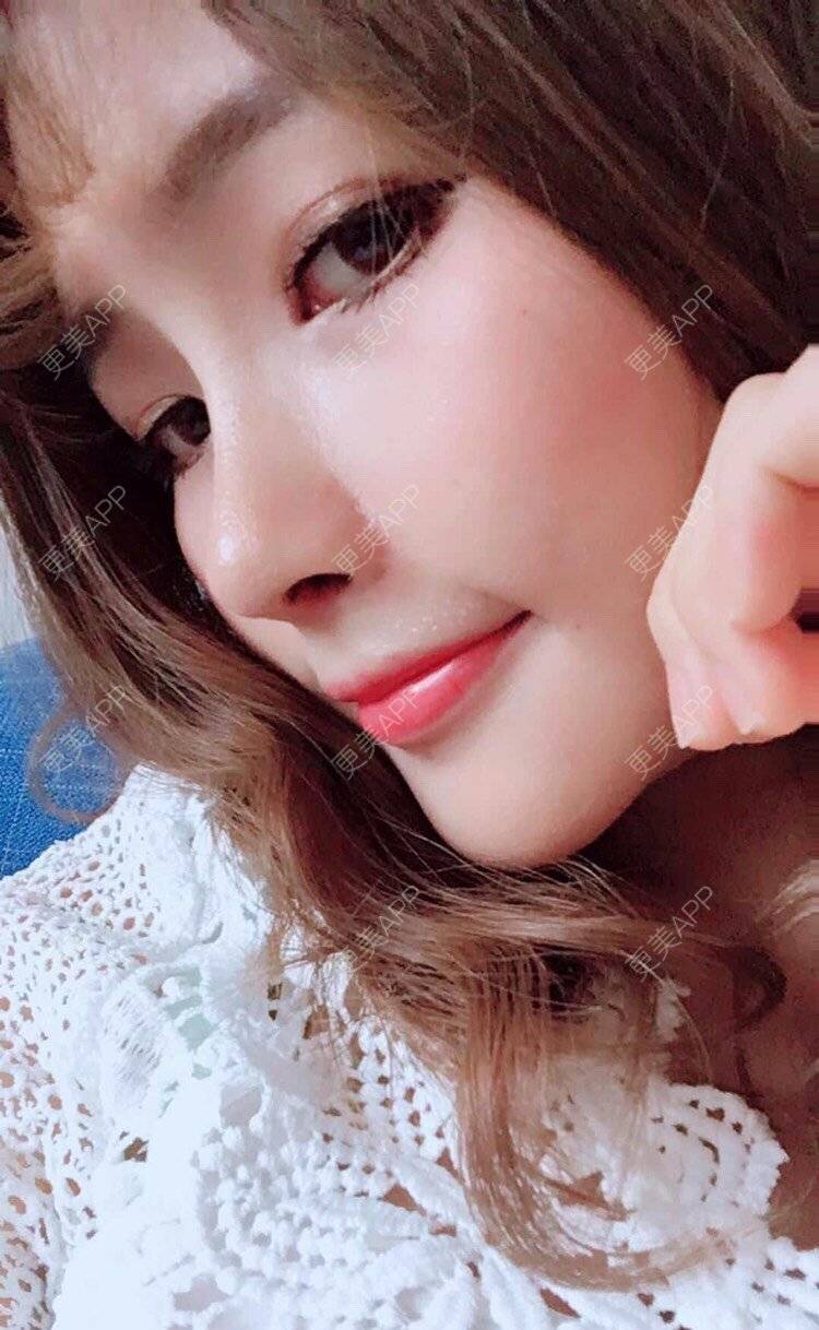 【上海】鼻综合_【上海】钕谋人姬鼻综合_鼻综合_术后396天__更美