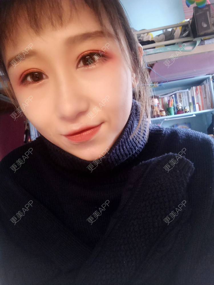 更美 - 周其光 医生的全切双眼皮经验 | 全切双眼皮 | 无锡
