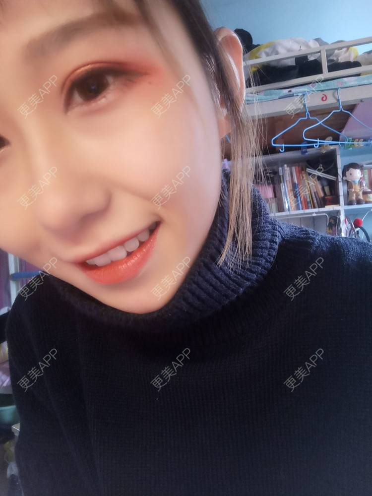 更美 - 周其光 医生的全切双眼皮经验 | 全切双眼皮 | 无锡