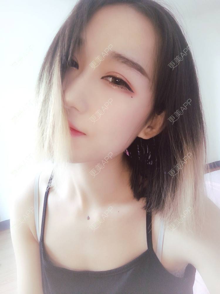 更美 - 周其光 医生的全切双眼皮经验 | 全切双眼皮 | 无锡