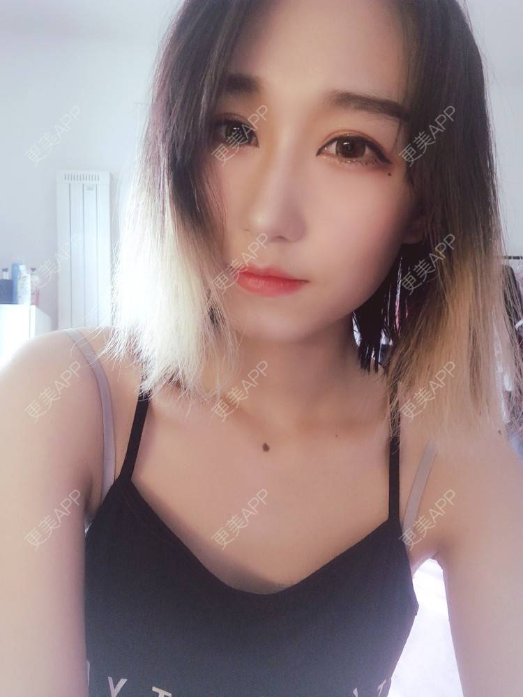 更美 - 周其光 医生的全切双眼皮经验 | 全切双眼皮 | 无锡