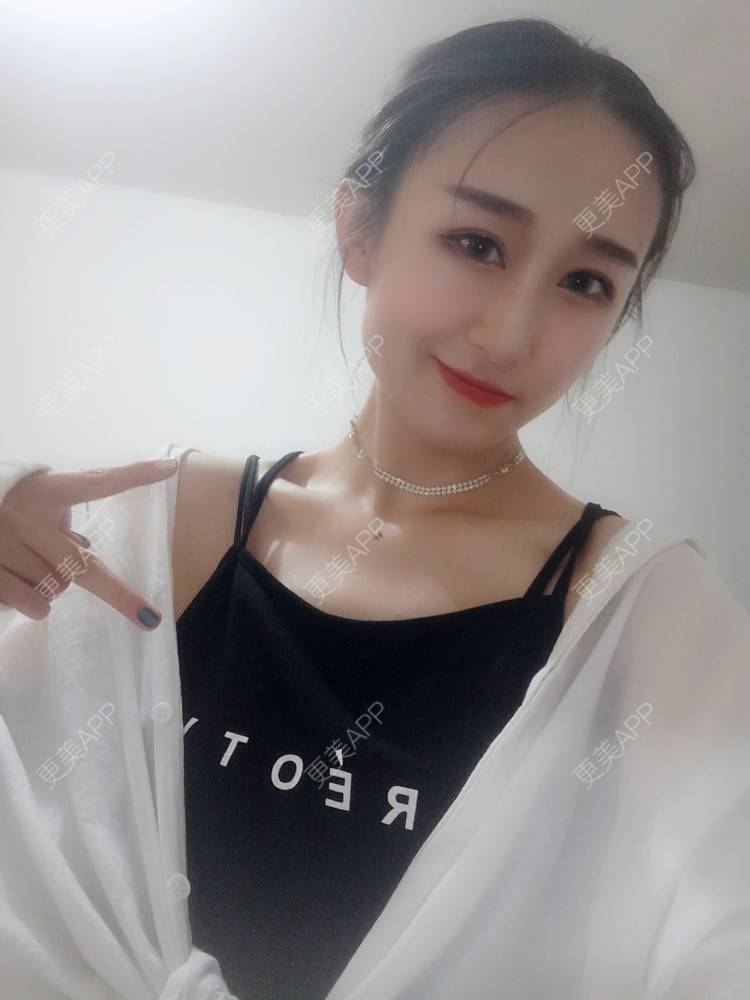 更美 - 周其光 医生的全切双眼皮经验 | 全切双眼皮 | 无锡