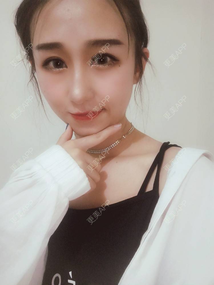 更美 - 周其光 医生的全切双眼皮经验 | 全切双眼皮 | 无锡