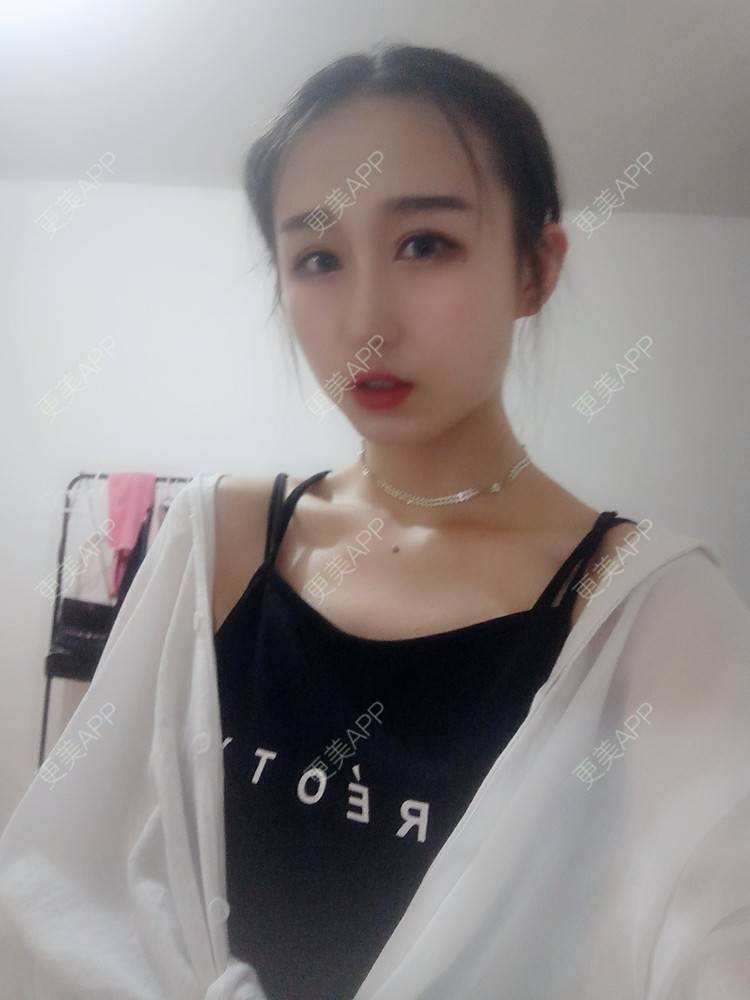 更美 - 周其光 医生的全切双眼皮经验 | 全切双眼皮 | 无锡