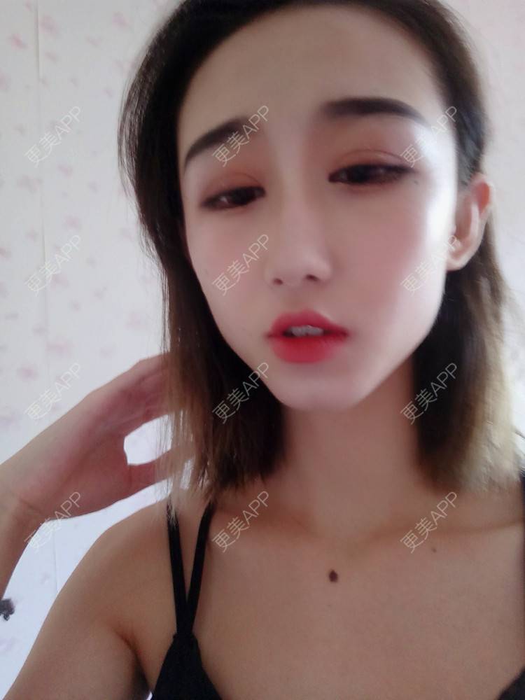 更美 - 周其光 医生的全切双眼皮经验 | 全切双眼皮 | 无锡