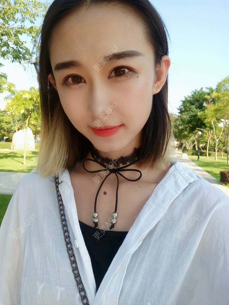 更美 - 周其光 医生的全切双眼皮经验 | 全切双眼皮 | 无锡