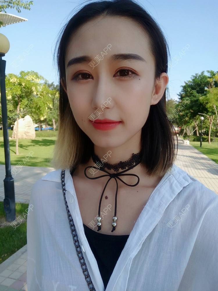 更美 - 周其光 医生的全切双眼皮经验 | 全切双眼皮 | 无锡