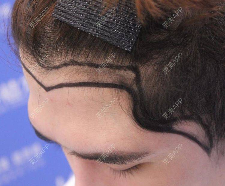 更美 - 更美用户zg540og93k的鬓角植发日记 | 植发际线 | 鬓角植发