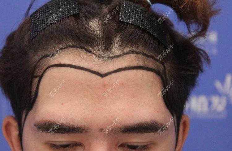 更美用户zg540og93k的鬓角植发日记