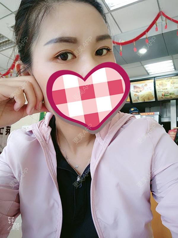 更美 - 杨丽 医生的双眼皮经验 | 双眼皮
