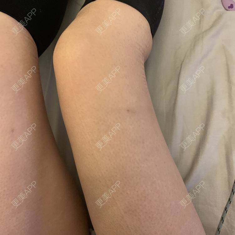 更美 - 更美用户JrJLC5yFo7的吸脂经验 | 吸脂 | 南京