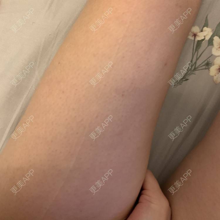 更美 - 更美用户JrJLC5yFo7的吸脂经验 | 吸脂 | 南京