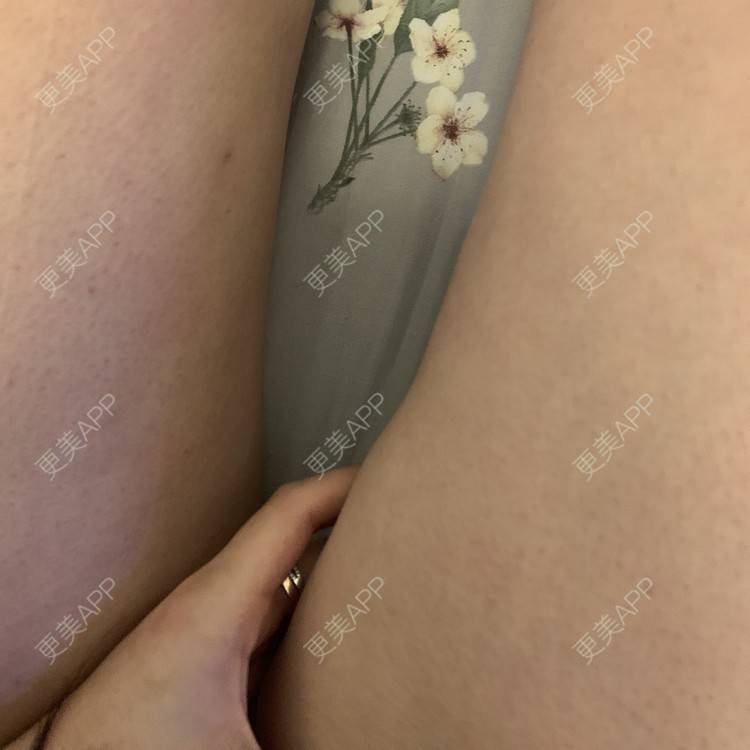 更美 - 更美用户JrJLC5yFo7的吸脂经验 | 吸脂 | 南京