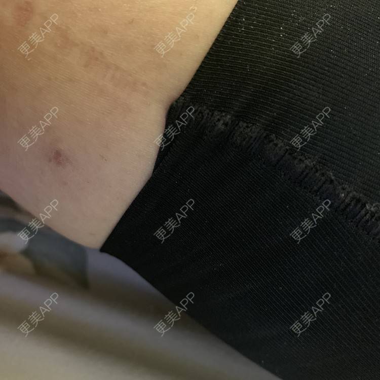 更美 - 更美用户JrJLC5yFo7的吸脂经验 | 吸脂 | 南京