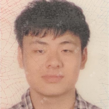 玻尿酸鼻部