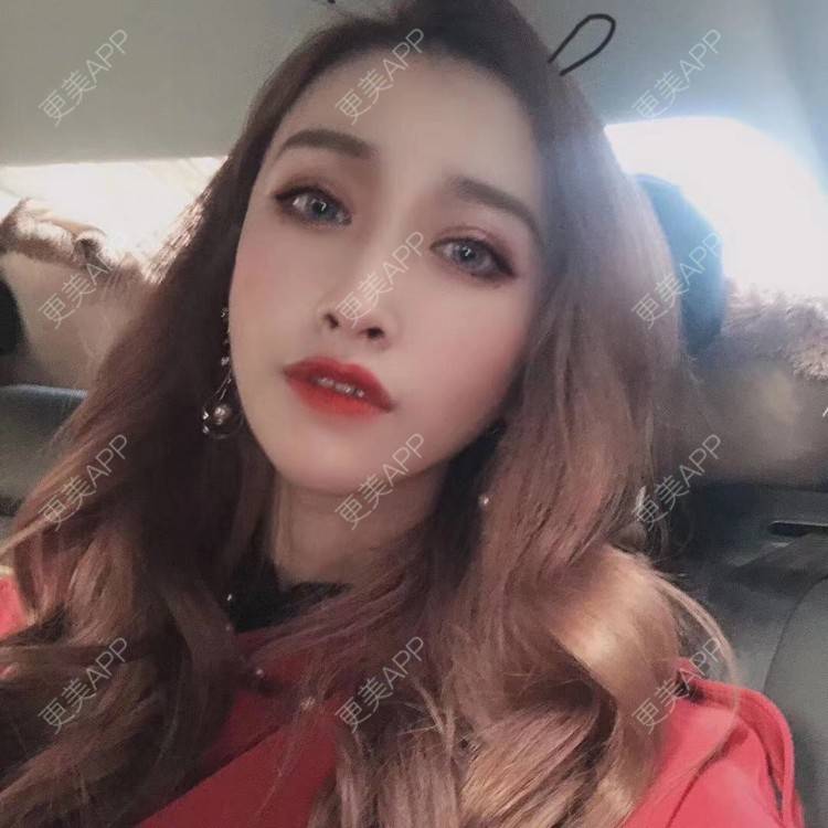 更美 - 丢了灵魂的孩纸的唇腭裂修复经验 | 厚唇改薄 | 唇腭裂修复 | 玻尿酸唇部 | 自体脂肪丰唇 | 胶原蛋白丰唇