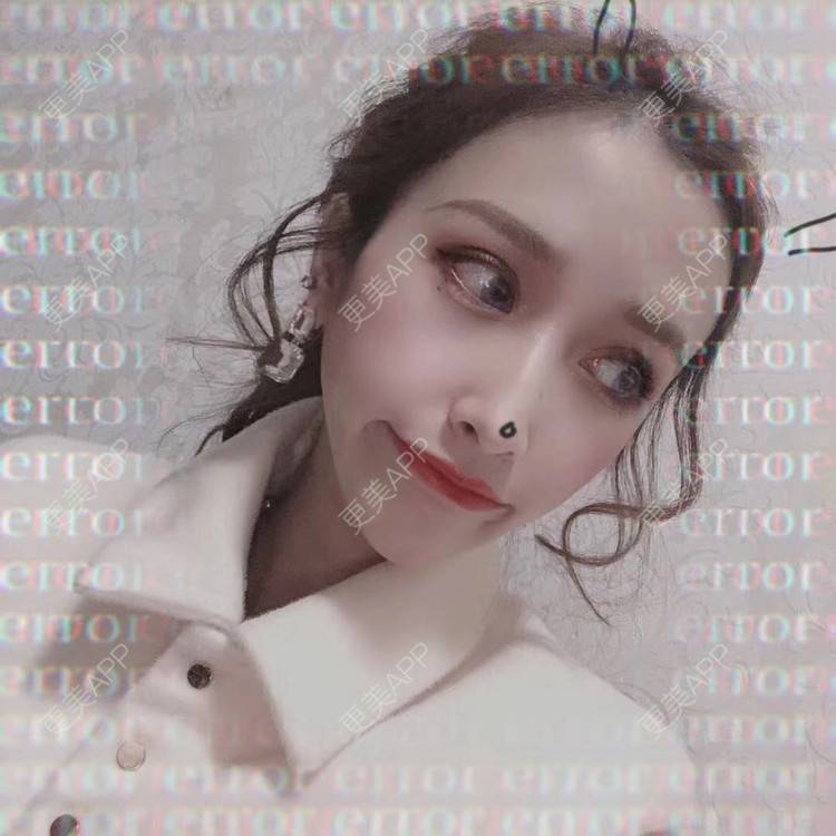更美 - 丢了灵魂的孩纸的唇腭裂修复经验 | 厚唇改薄 | 唇腭裂修复 | 玻尿酸唇部 | 自体脂肪丰唇 | 胶原蛋白丰唇