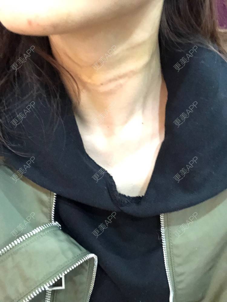 更美 - 更美用户IghjRWworf的自体脂肪填充颈纹经验 | 自体脂肪填充颈纹 | 重庆