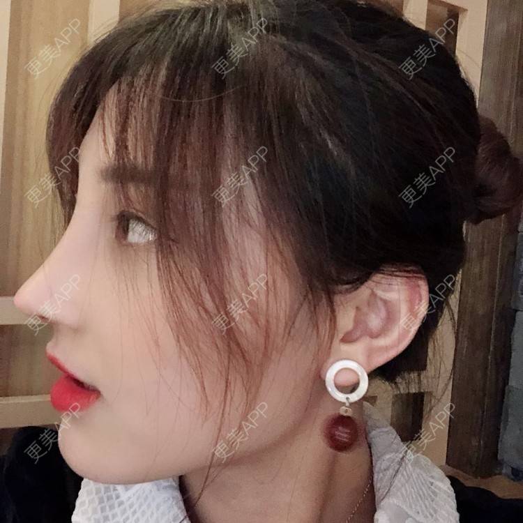 更美用户4yor1oavml的鼻小柱延长日记