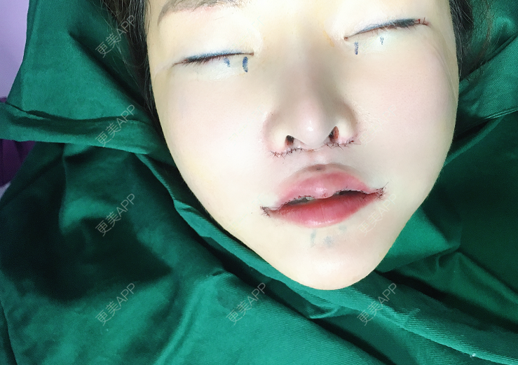 更美用户z0ryff3wgm的m唇成形术日记