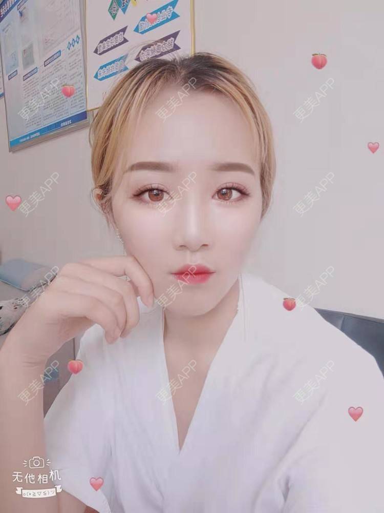 更美 - 更美用户cZDofR1cWa的双眼皮修复经验 | 成都 | 双眼皮修复