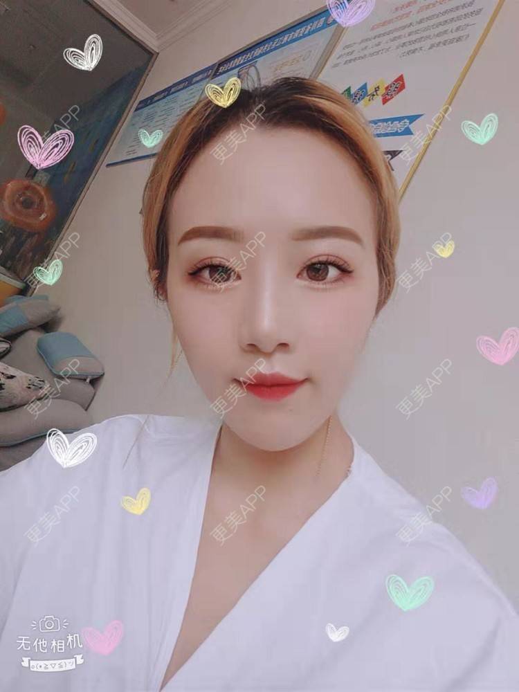 更美 - 更美用户cZDofR1cWa的双眼皮修复经验 | 成都 | 双眼皮修复
