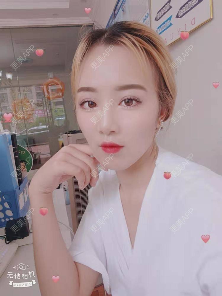 更美 - 更美用户cZDofR1cWa的双眼皮修复经验 | 成都 | 双眼皮修复