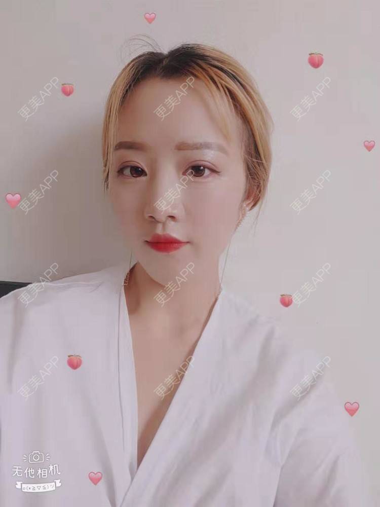 更美 - 更美用户cZDofR1cWa的双眼皮修复经验 | 成都 | 双眼皮修复