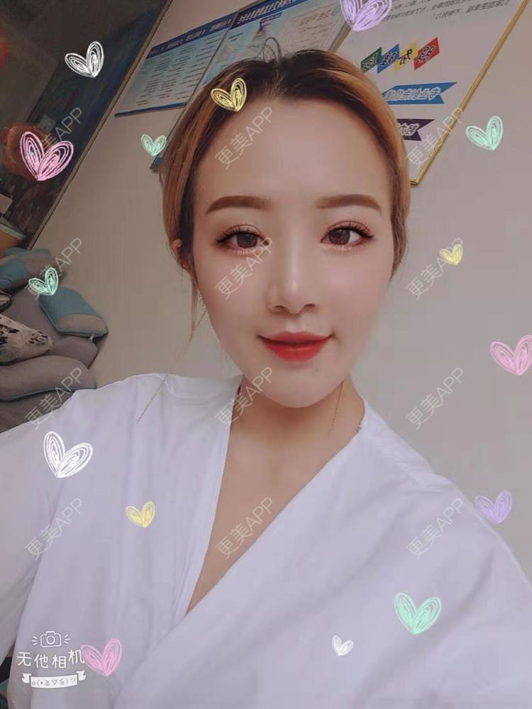 更美 - 更美用户cZDofR1cWa的双眼皮修复经验 | 成都 | 双眼皮修复