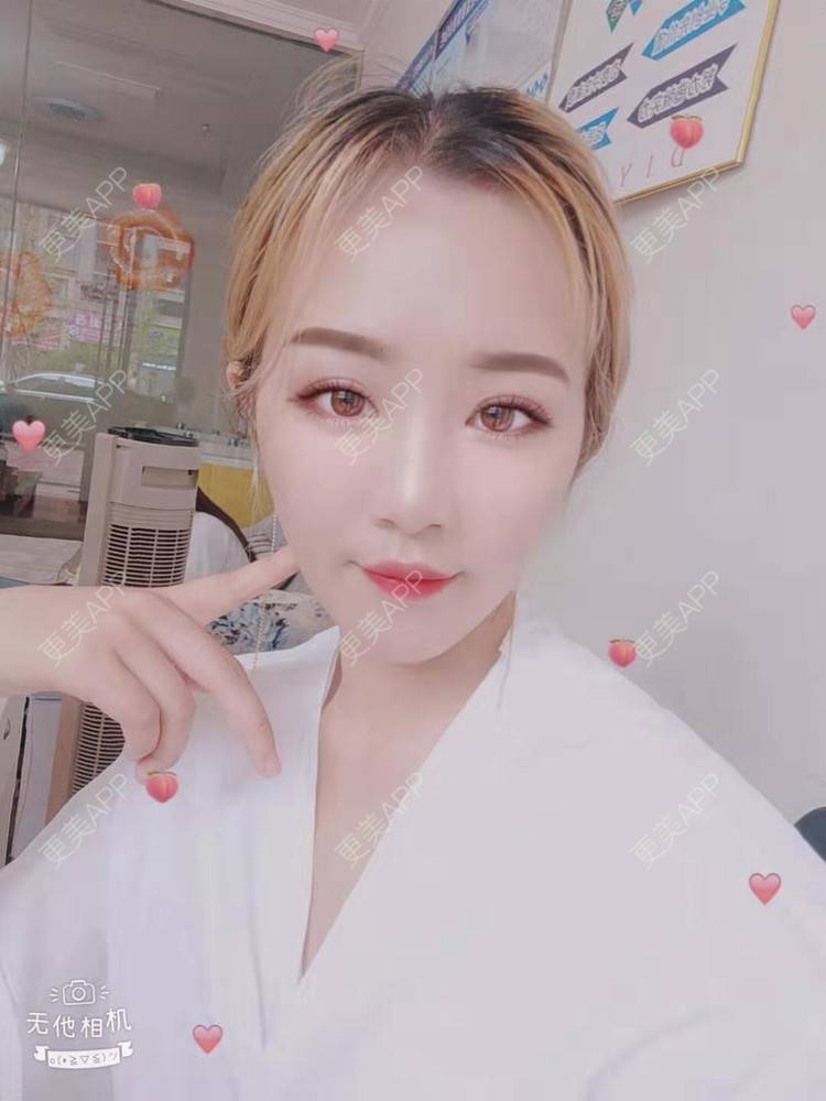 更美 - 更美用户cZDofR1cWa的双眼皮修复经验 | 成都 | 双眼皮修复