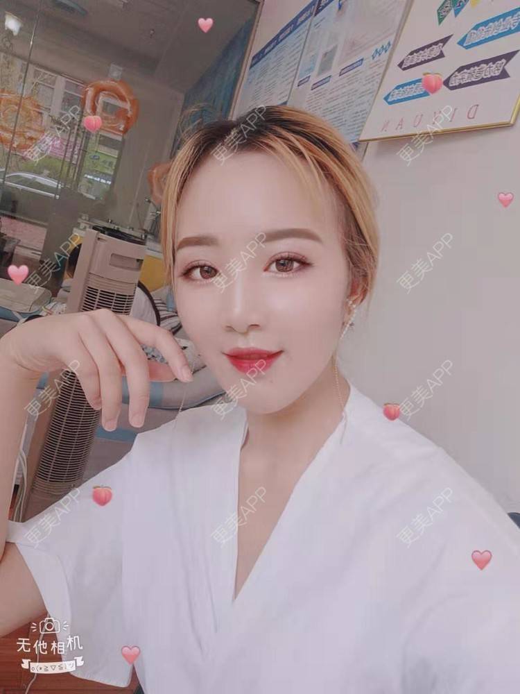 更美 - 更美用户cZDofR1cWa的双眼皮修复经验 | 成都 | 双眼皮修复