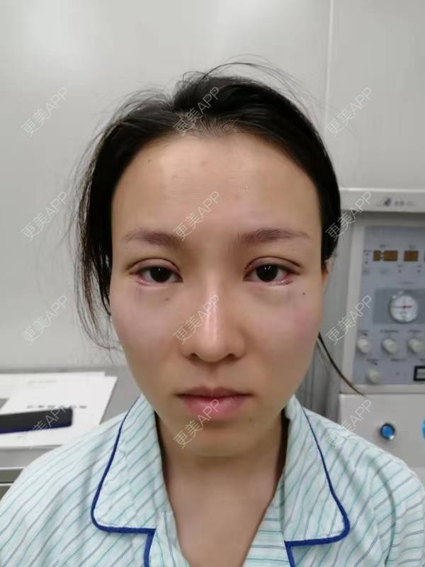 更美 - 更美用户qfawibPOtx的开眼角经验 | 开眼角 | 深圳