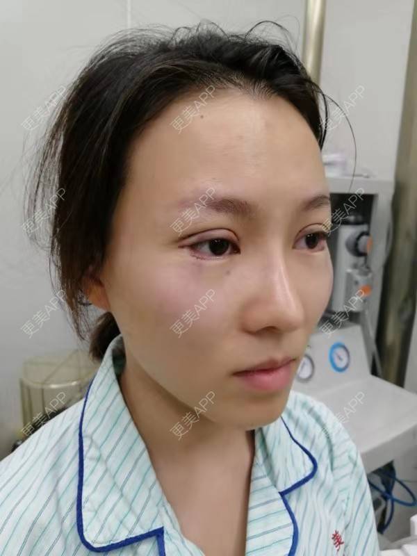 更美 - 更美用户qfawibPOtx的开眼角经验 | 开眼角 | 深圳