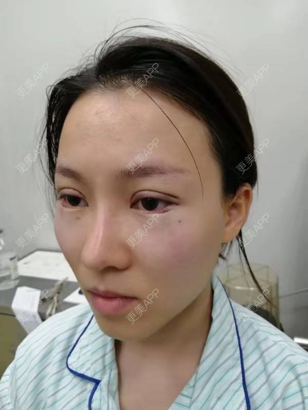 更美 - 更美用户qfawibPOtx的开眼角经验 | 开眼角 | 深圳