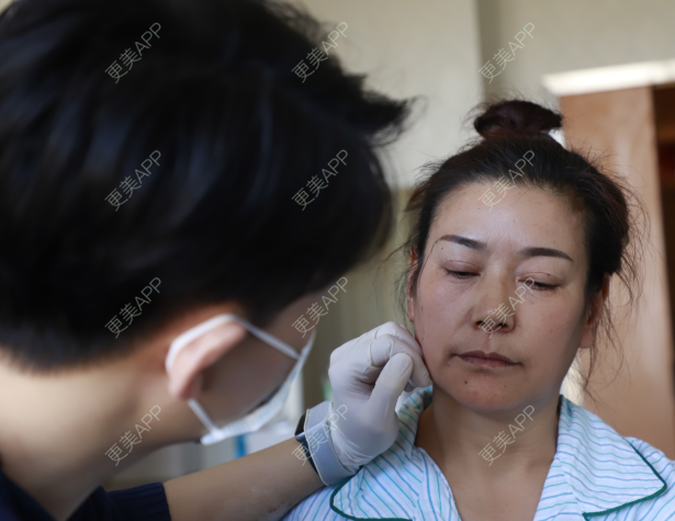 提拉苹果肌手术_苹果肌提升手术_提升苹果肌什么手术效果最好