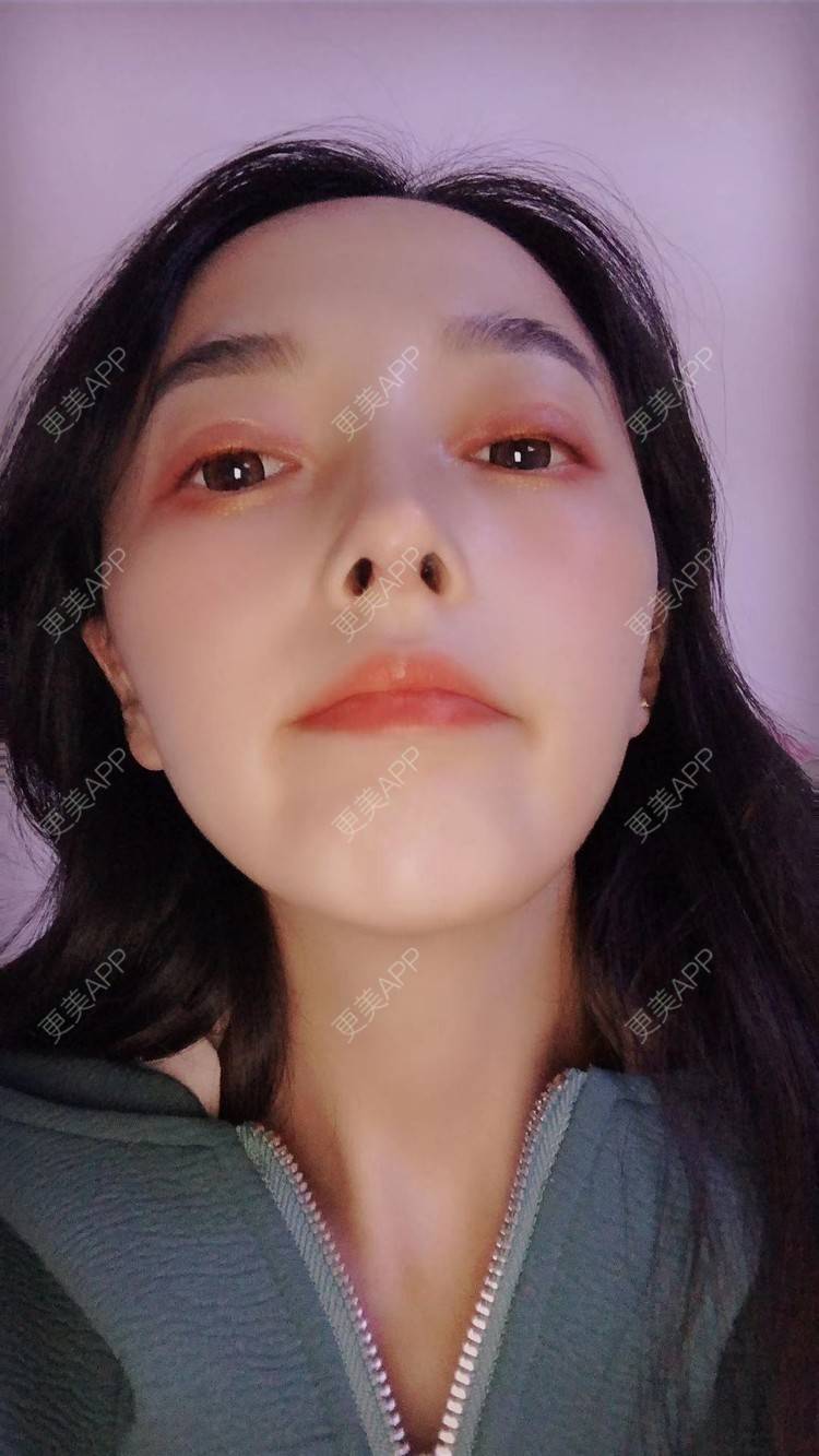 更美 - 还很喜欢你哟的鼻部多项经验 | 鼻部多项 | 重庆 | 鼻孔矫正 | 鼻翼缩小