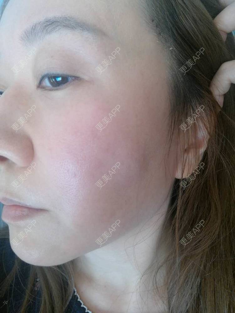 高铁时速多少的拉皮手术日记