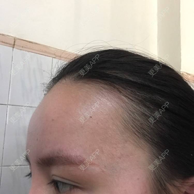 更美 - 更美用户4Hyjx7UQA2的半永久纹发际线经验 | 惠州 | 半永久纹发际线