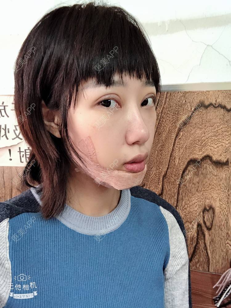 更美 - 🍬肉肉肉肉丝的下巴经验 | 硅胶垫下巴 | 下巴 | 哈尔滨