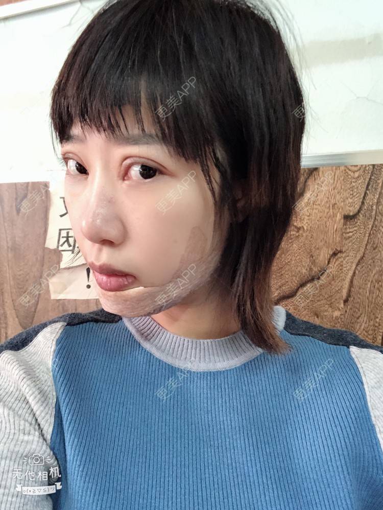更美 - 🍬肉肉肉肉丝的下巴经验 | 硅胶垫下巴 | 下巴 | 哈尔滨