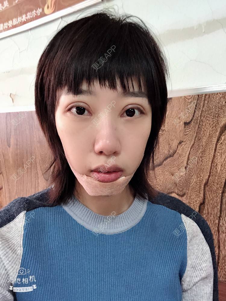 更美 - 🍬肉肉肉肉丝的下巴经验 | 硅胶垫下巴 | 下巴 | 哈尔滨
