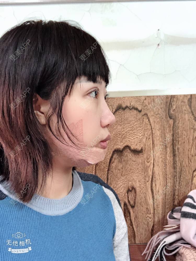 更美 - 🍬肉肉肉肉丝的下巴经验 | 硅胶垫下巴 | 下巴 | 哈尔滨